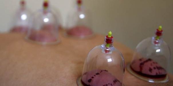 Hijama