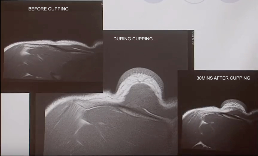 MRI scan before, during and after cupping